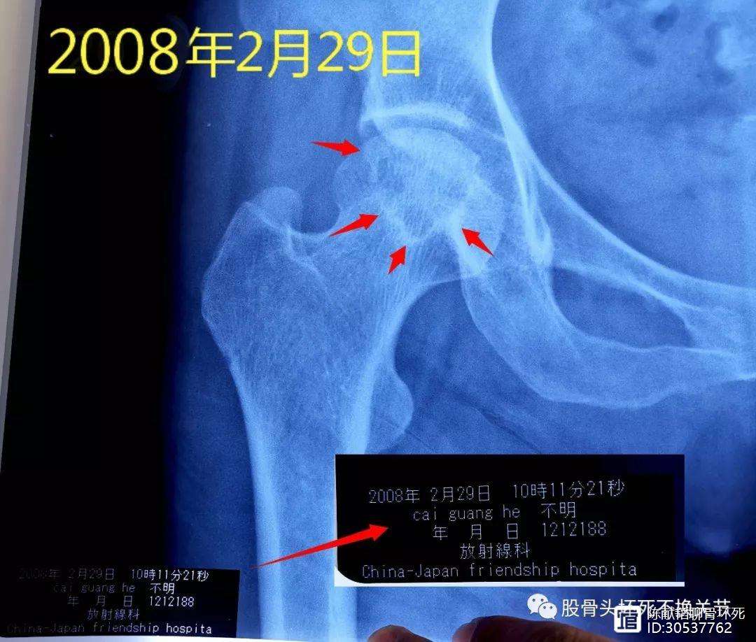 南阳人工骨头医保报销多少(人工骨头医保报销多少比例)